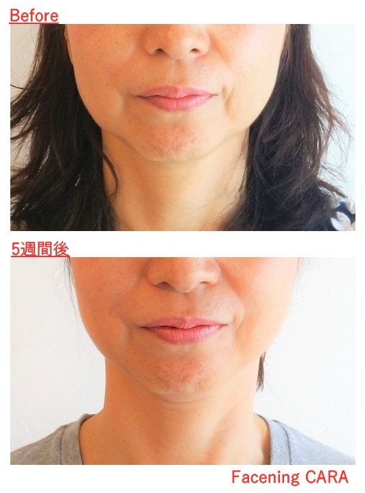 頬のたるみを 表情筋トレーニング で改善 Cara